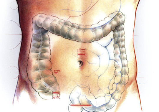 Colon Cancer Naples Colon Cancer Naples